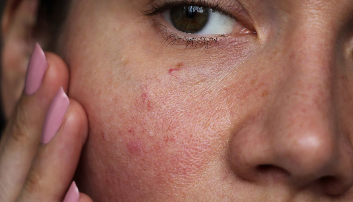 How to Identify Sensitive Skin and Why Natural Vegan Mineral Sunscreens Are Essential